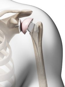 Shoulder Surgery - Orlando Orthopaedic Center -Reuss
